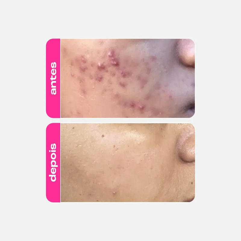 Ácido Mandélico – Gel Clareador Antiacne